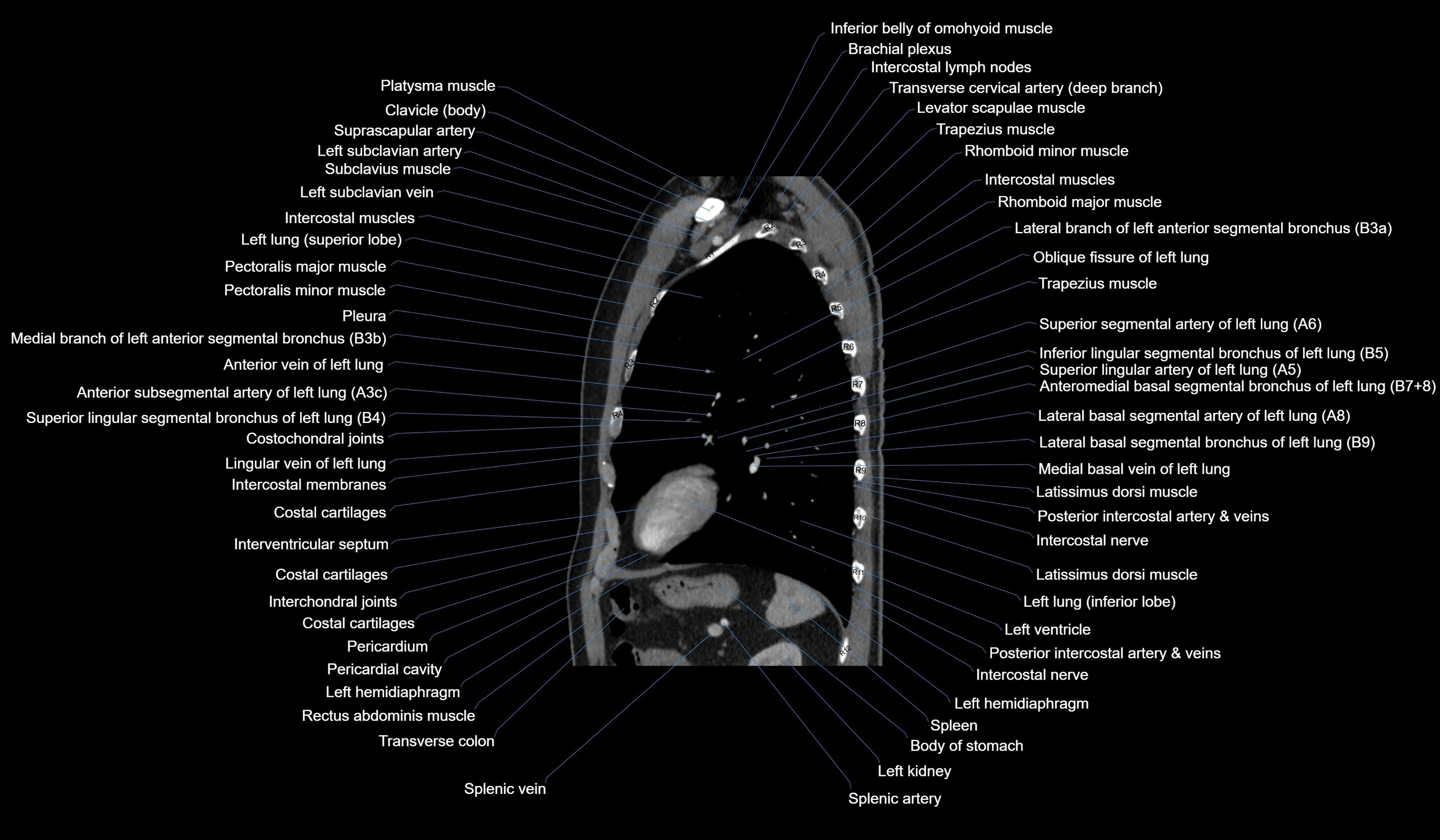 CT chest (thorax) labelled sagittal cross sectional anatomy radiology image-00101.webp